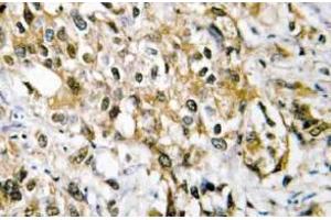 Immunohistochemistry (IHC) analyzes of c-Myc antibody in paraffin-embedded human liver carcinoma tissue. (c-MYC anticorps)