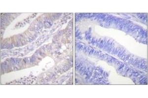 Immunohistochemistry analysis of paraffin-embedded human colon carcinoma tissue, using CFTR (Ab-737) Antibody.