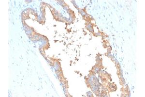 Formalin-fixed, paraffin-embedded human Prostate Carcinoma stained with Transferrin Mouse Monoclonal Antibody (TF/3001).