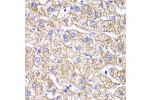 Immunohistochemistry of paraffin-embedded human liver damage using DLST antibody (ABIN6130277, ABIN6139665, ABIN6139667 and ABIN6217240) at dilution of 1:100 (40x lens).