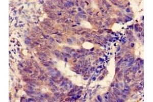 Immunohistochemistry of paraffin-embedded human colon cancer using ABIN7159726 at dilution of 1:100 (MGST2 anticorps  (AA 27-57))