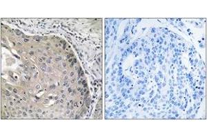 Immunohistochemistry analysis of paraffin-embedded human lung carcinoma tissue, using AOX1 Antibody.