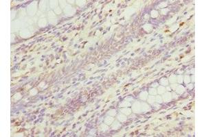 Immunohistochemistry of paraffin-embedded human colon cancer using ABIN7167615 at dilution of 1:100