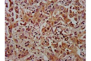 IHC image of ABIN7175929 diluted at 1:1000 and staining in paraffin-embedded human liver cancer performed on a Leica BondTM system. (XKR8 anticorps  (AA 69-158))
