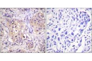Immunohistochemistry analysis of paraffin-embedded human breast carcinoma, using PKC-pan (Phospho-Thr497) Antibody. (PKC anticorps  (pThr497))