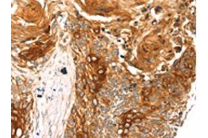 The image on the left is immunohistochemistry of paraffin-embedded Human esophagus cancer tissue using ABIN7192788(THAP9 Antibody) at dilution 1/20, on the right is treated with synthetic peptide. (THAP9 anticorps)