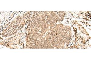 Immunohistochemistry of paraffin-embedded Human esophagus cancer tissue using VPS50 Polyclonal Antibody at dilution of 1:45(x200) (Syndetin/VPS50 anticorps)