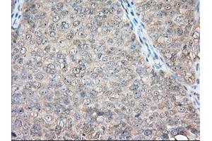Immunohistochemical staining of paraffin-embedded Adenocarcinoma of Human colon tissue using anti-BSG mouse monoclonal antibody. (CD147 anticorps)