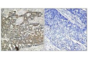 Immunohistochemical analysis of paraffin-embedded human breast carcinoma tissue using p56Dok-2(Phospho-Tyr299) Antibody(left) or the same antibody preincubated with blocking peptide(right). (DOK2 anticorps  (pTyr299))