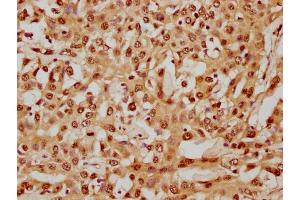 IHC image of nhibHU diluted at 1:8 and staining in paraffin-embedded human liver cancer performed on a Leica BondTM system.