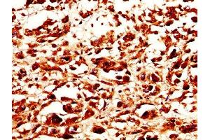 IHC image of ABIN7159229 diluted at 1:200 and staining in paraffin-embedded human melanoma performed on a Leica BondTM system.