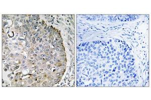 Immunohistochemistry analysis of paraffin-embedded human lung carcinoma tissue, using MRRF antibody. (MRRF anticorps  (C-Term))