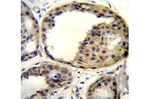 AKT1 antibody immunohistochemistry analysis in formalin fixed and paraffin embedded human breast carcinoma
