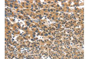 The image on the left is immunohistochemistry of paraffin-embedded Human liver cancer tissue using ABIN7192978(UBTD2 Antibody) at dilution 1/35, on the right is treated with synthetic peptide. (UBTD2 anticorps)
