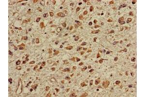 Immunohistochemistry of paraffin-embedded human glioma using ABIN7150673 at dilution of 1:100 (TGDS anticorps  (AA 143-305))