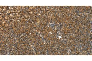 Immunohistochemistry of paraffin-embedded Human lymphoma using TEKT1 Polyclonal Antibody at dilution of 1:30