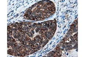 Immunohistochemical staining of paraffin-embedded Adenocarcinoma of breast tissue using anti-XRCC1 mouse monoclonal antibody. (XRCC1 anticorps)