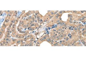 Immunohistochemistry of paraffin-embedded Human thyroid cancer tissue using CABP5 Polyclonal Antibody at dilution of 1:65(x200)