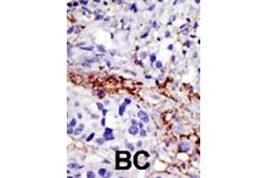 Formalin-fixed and paraffin-embedded human cancer tissue reacted with the primary antibody, which was peroxidase-conjugated to the secondary antibody, followed by DAB staining. (USP21 anticorps  (C-Term))