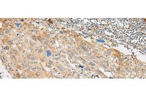 Immunohistochemistry of paraffin-embedded Human cervical cancer tissue using GPR151 Polyclonal Antibody at dilution of 1:45(x200) (GPR151 anticorps)