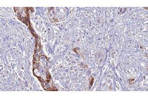 ABIN6274126 at 1/100 staining Human urothelial cancer tissue by IHC-P.
