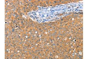 The image on the left is immunohistochemistry of paraffin-embedded Human cervical cancer tissue using ABIN7128218(ACY3 Antibody) at dilution 1/25, on the right is treated with fusion protein. (Aminoacylase 3 anticorps)