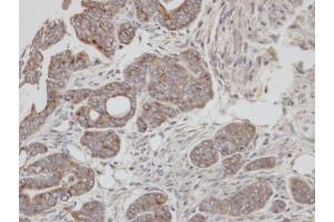 IHC-P Image Immunohistochemical analysis of paraffin-embedded N87 xenograft, using RAB2A, antibody at 1:100 dilution. (RAB2A anticorps  (C-Term))