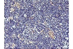 Immunohistochemical staining of paraffin-embedded Human lymphoma tissue using anti-DPP9 mouse monoclonal antibody. (DPP9 anticorps)