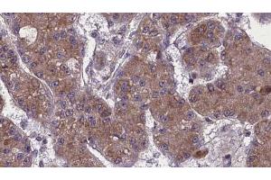 ABIN6272759 at 1/100 staining Human liver cancer tissue by IHC-P. (OR52K2 anticorps)