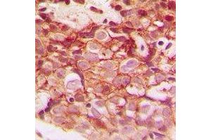 Immunohistochemical analysis of CLIP3 staining in human breast cancer formalin fixed paraffin embedded tissue section.