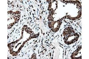 Immunohistochemical staining of paraffin-embedded Adenocarcinoma of ovary tissue using anti-PSMC3 mouse monoclonal antibody. (PSMC3 anticorps)