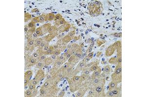 Immunohistochemistry of paraffin-embedded human liver injury using FOXO3 antibody (ABIN2736768) at dilution of 1:100 (40x lens). (FOXO3 anticorps)