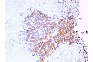 Formalin-fixed, paraffin-embedded human Melanoma stained with Topo I, MT Mouse Monoclonal Antibody (TOP1MT/568) (TOP1MT anticorps)