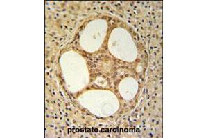 PRUNE Antibody IHC analysis in formalin fixed and paraffin embedded prostate carcinoma followed by peroxidase conjugation of the secondary antibody and DAB staining. (PRUNE anticorps  (C-Term))