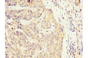 IHC image of ABIN7170156 diluted at 1:300 and staining in paraffin-embedded human liver cancer performed on a Leica BondTM system. (SLC22A25 anticorps  (AA 31-145))