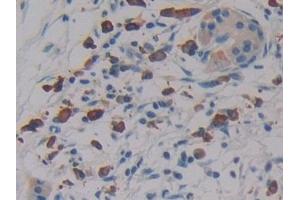 Detection of LAT2 in Human Pancreatic cancer Tissue using Polyclonal Antibody to Linker For Activation Of T-Cells Family, Member 2 (LAT2)