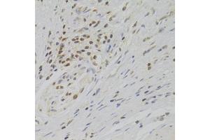Immunohistochemistry of paraffin-embedded human gastric cancer using TAF1C Antibody (ABIN2560282) at dilution of 1:100 (40x lens). (TAF1C anticorps)