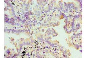 Immunohistochemistry of paraffin-embedded human lung cancer using ABIN7170658 at dilution of 1:100
