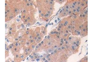 Detection of IL33 in Human Stomach cancer Tissue using Monoclonal Antibody to Interleukin 33 (IL33)