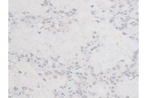 ABIN6267554 at 1/200 staining Human lung cancer tissue sections by IHC-P.