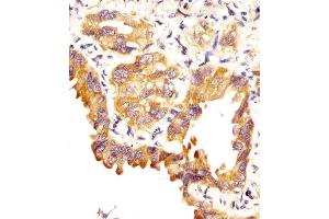 (ABIN657607 and ABIN2846604) staining SFTPC in human lung adenocarcinoma sections by Immunohistochemistry (IHC-P - paraformaldehyde-fixed, paraffin-embedded sections).