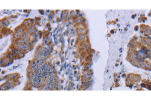 Immunohistochemistry of paraffin-embedded Human esophagus cancer tissue using MT3 Polyclonal Antibody at dilution 1:50 (MT3 anticorps)