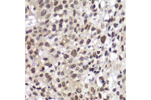 Immunohistochemistry of paraffin-embedded human lung cancer using CHEK2 antibody at dilution of 1:100 (400x lens).