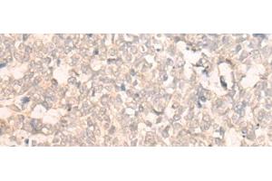 Immunohistochemistry of paraffin-embedded Human lung cancer tissue using FAN1 Polyclonal Antibody at dilution of 1:30(x200)