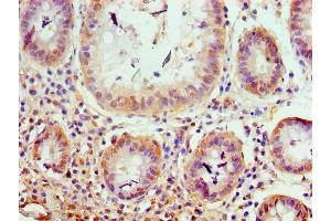 Immunohistochemistry of paraffin-embedded human colon cancer using ABIN7176599 at dilution of 1:100 (TRIM27 anticorps  (AA 214-513))