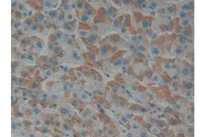 Detection of EDN1 in Human Liver cancer Tissue using Polyclonal Antibody to Endothelin 1 (EDN1) (Endothelin 1 anticorps  (AA 53-90))