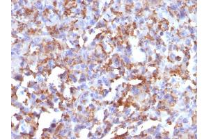 Formalin-fixed, paraffin-embedded human Histiocytoma stained with CD68 Mouse Monoclonal Antibody (LAMP4/824). (CD68 anticorps)