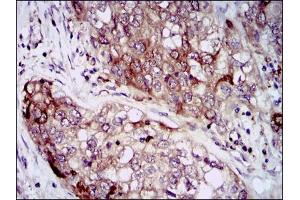 Immunohistochemical analysis of paraffin-embedded lung cancer tissues using HSP90AA1 mouse mAb with DAB staining.