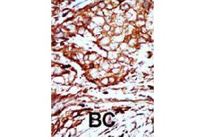 Formalin-fixed and paraffin-embedded human breast cancer tissue reacted with YWHAB polyclonal antibody  , which was peroxidase-conjugated to the secondary antibody, followed by AEC staining. (YWHAB anticorps  (C-Term))