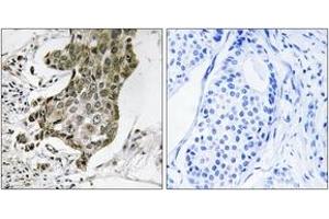 Immunohistochemistry analysis of paraffin-embedded human breast carcinoma tissue, using RABEP1 Antibody.